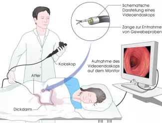 Darmspiegelung