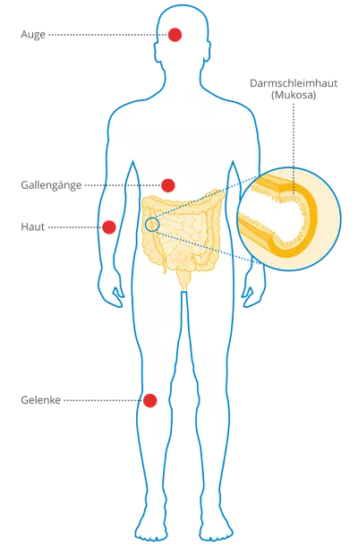 Morbus Crohn - Was passiert Silhouette